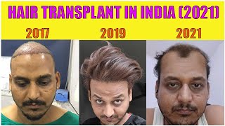 Hair Transplant result after 4 years 2021 INDIA [upl. by Aundrea55]