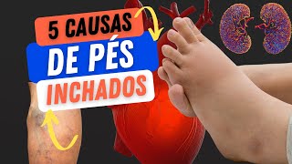 5 causas de pés inchados [upl. by Hebe]