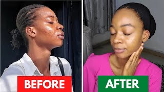 25 DAYS SKIN TRANSFORMATION USING TRETINOINHow Tretinoin saved my Skin Before amp After drpurity [upl. by Petula967]