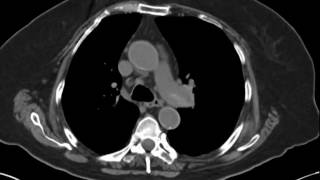 Pulmonary Embolism by NonContrast CT JETem 2017 [upl. by Rimaj939]