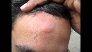 Head Injury Bump Home Treatment [upl. by Inohs]