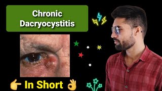 Chronic Dacryocystitis lecture opthalmology in short [upl. by Voe]