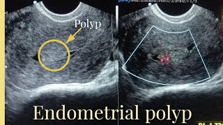 Ultrasound Report of endometrial polyp Sonography of Endometrial masspolyp [upl. by Ttiwed146]