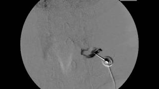 Axial view of C8 selective nerve root block by lateral and prone approaches [upl. by Richela925]