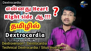 Dextrocardia in tamil  right side heart in tamil  dextroversion  technical dextrocardia [upl. by Nahsor]