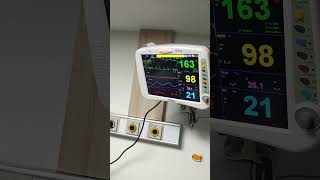 DefibrillationCardioversion in SupraVenticular tachycardia [upl. by Darice]