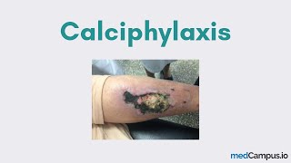 Calciphylaxis CUA [upl. by Adniralc292]