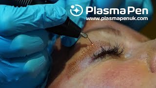 Plasma Pen  Louise Walsh International  Before amp Afters  How We Get These Results [upl. by Blisse]