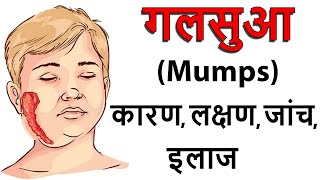 गलसुआ mumps कनफेड कण्ठमाला का रोग  क्या है क्यों होता है क्या खाना चाहिए बचाव कैसे करे [upl. by Nada]