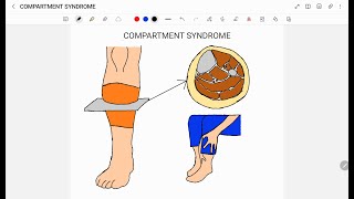 COMPARTMENT SYNDROME [upl. by Fryd]