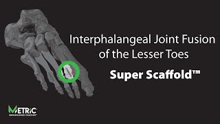 Interphalangeal Joint Fusion of the Lesser Toes  Super Scaffold ™ [upl. by Dlareme136]