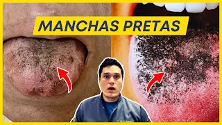 Língua com manchas pretas O que pode ser [upl. by Neelra457]