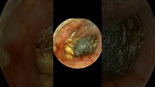 COMPLETE Package Of Earwax With Fungi [upl. by Amek]