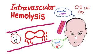 Intravascular Hemolysis [upl. by Arebma]