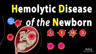 Hemolytic Disease of the Newborn HDN Animation [upl. by Ambrosane]