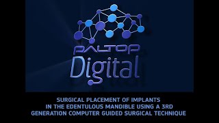 Placement of Implants in the Edentulous Mandible using a Computer Guided Technique [upl. by Dieball]