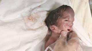 Newborn baby abandoned by parents due to congenital malformations just after birth birth [upl. by Alanna]