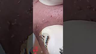 Skincare  Blackheads Removal 167 skincare skincare blackheads blackheads [upl. by Alaecim894]