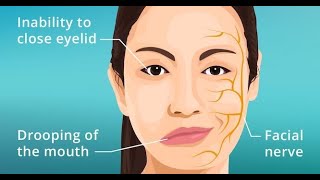 Symptoms Features and Presentations of Bells palsy [upl. by Naujal748]