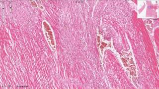 Myocardial Infarction  Histopathology [upl. by Vergil]