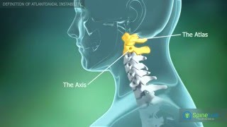 Atlantoaxial instability Definition [upl. by Aernda813]