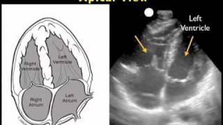 How to Cardiac Ultrasound  Apical View Case Study [upl. by Kenti635]