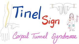 Tinel Sign  Carpal Tunnel Syndrome [upl. by Kano13]