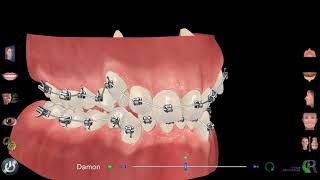 Traitement orthodontie avec bagues Dr Eric Ursat Strasbourg [upl. by Sulrac586]