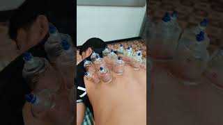 upper back pain cupping therapy bestphysiotherapycenter [upl. by Lora]