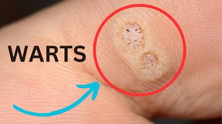 GET RID OF WARTS Heres How [upl. by Licec]