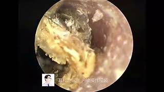 Hard external auditory canal cholesteatoma and small earwax [upl. by Ericka]