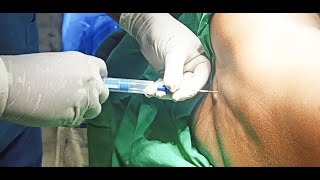 Epidural Anaesthesia  2  techniques  DrSParthasarathy MDDNB PhD [upl. by Dimah]