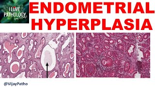 ENDOMETRIAL HYPERPLASIA  Etiopathogenesis classification Diagnosis amp treatment [upl. by Sandler300]