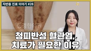 청피반성 혈관염 괴사가 생길 확률은 얼마나 되나요 What are the chances of developing necrosis from livedoid vasculitis [upl. by Davies626]