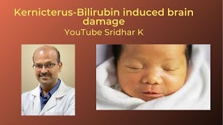 Kernicterus and BIND bilirubin induced neurologic damage Dr Sridhar K [upl. by Hairaza]