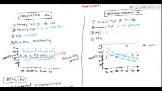 Conductive and Sensorineural Hearing Loss Deafness for USMLE [upl. by Nnhoj]