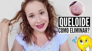 COMO ELIMINAR QUELOIDE DO PIERCING  DUAS DICAS  POR LEYA ARAGÃO [upl. by Keg]