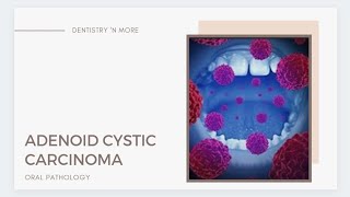 ADENOID CYSTIC CARCINOMA [upl. by Nilek]