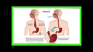 Behandlung für Achalasie [upl. by Margette]