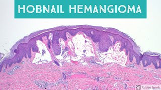 Hobnail Hemangioma Targetoid Hemosiderotic Hemangioma Retiform Hemangioendothelioma and Mimics [upl. by Rehteh]