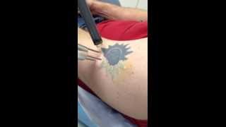 Laser Tattoo Removal at Dr Tattoff [upl. by Omrellig987]