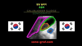 초음파 담낭 슬러지 [upl. by Ibmab]