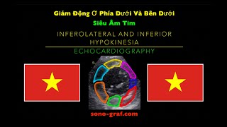 Siêu Âm Tim  Giảm Động Ơ Phía Dưới Và Bên Dưới [upl. by Ylloh97]