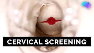 Cervical Screening SMEAR  OSCE Guide  UKMLA  CPSA [upl. by Birmingham955]