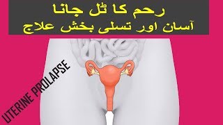 Uterine Prolapse  Causes Symptoms amp Treatment  Iqbal Health Centre [upl. by Cappella]