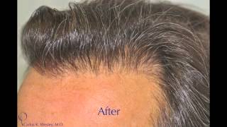 Sectioned Scalp FUE and Beard to Scalp FUE [upl. by Bergmann]