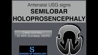 Semilobar holoprosencephaly CLASSIC [upl. by Retep93]