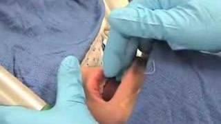 IntubationHow to perform endotracheal intubation  2 [upl. by Etnaik]