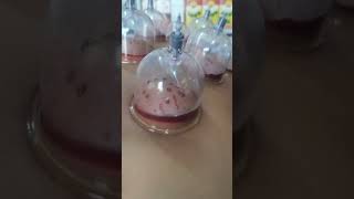 Hijama therapy हिजामा चिकित्सा लीलाधर प्रधान मार्केट शाहपुर बम्हैटा गांव मैन गेट निकट आत्मा स्टील। [upl. by Anagrom128]