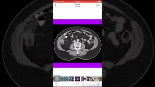 Case 072 Epiploic appendagitis [upl. by Aicetel]